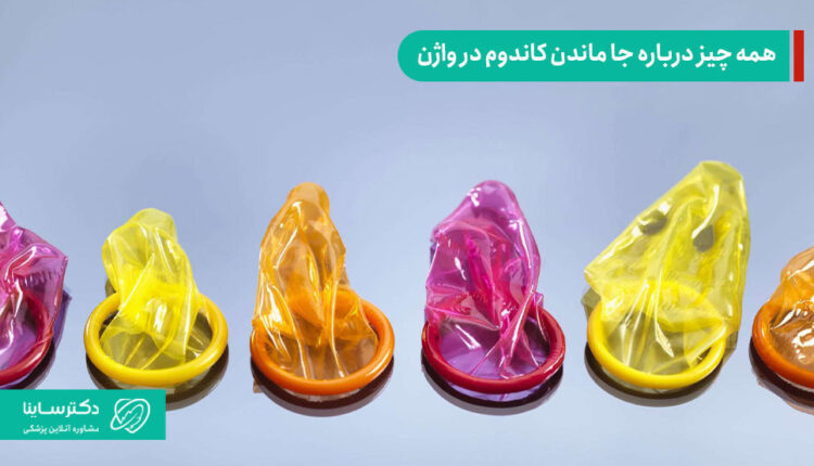 جا ماندن کاندوم در واژن