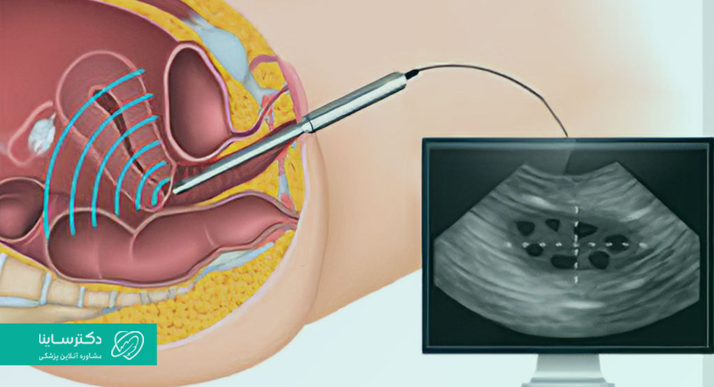  برای انجام سونو واژینال، پروب وارد واژن می‌شود و از محیط داخلی واژن و دهانه رحم تصویربرداری می‌کند.
