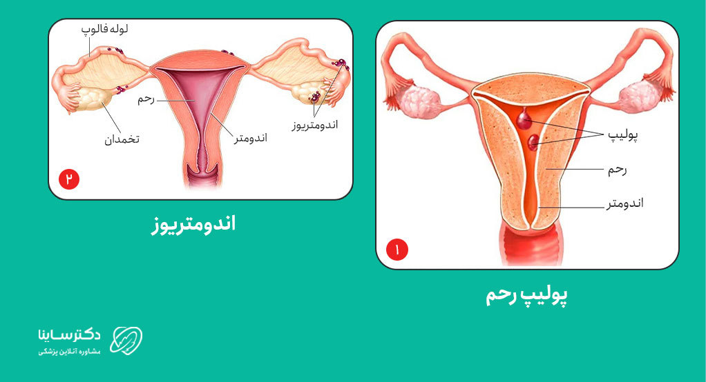 اندومتریوز و پولیپ رحم می‌توانند باعث ترشحات غیرطبیعی قهوه‌ای واژن شوند.