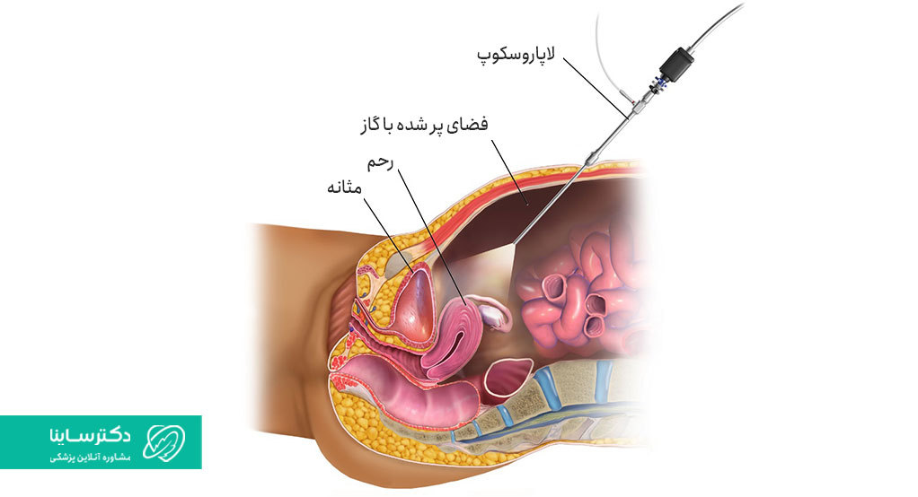 برای انجام عمل توبکتومی در روش لاپاروسکوپی فقط یک حفره کوچک روی پوست شکم ایجاد می‌شود.
