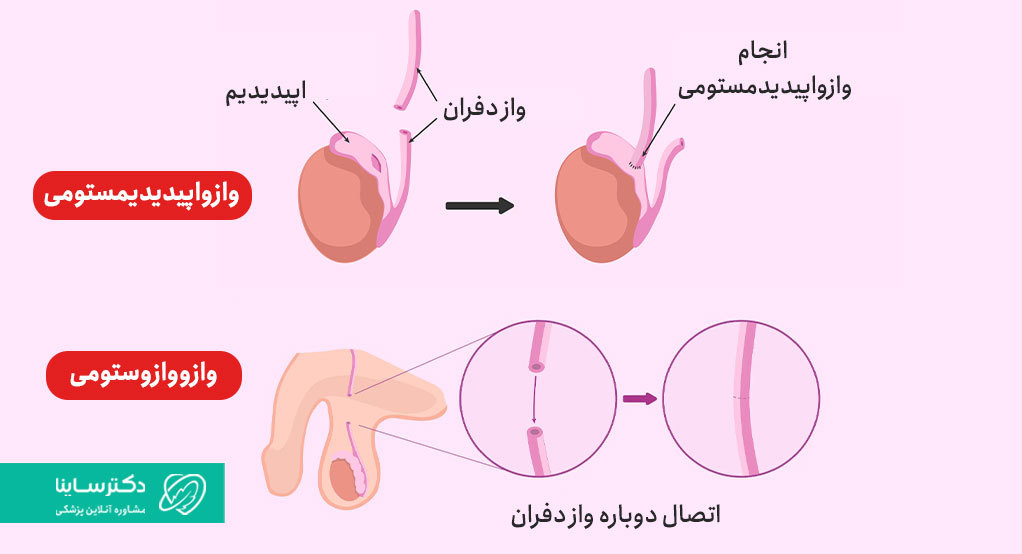 عمل بازگشت وازکتومی به دو روش وازووازستومی و وازواپیدیدیموستومی انجام می‌شود.
