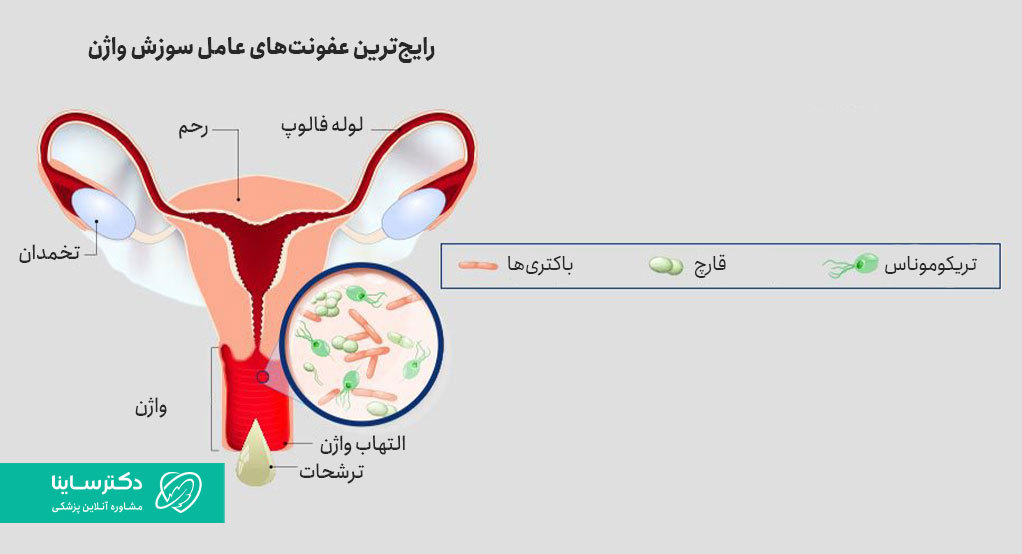 قارچ، باکتری و تریکوموناس از رایج‌ترین علل سوزش واژن هستند.