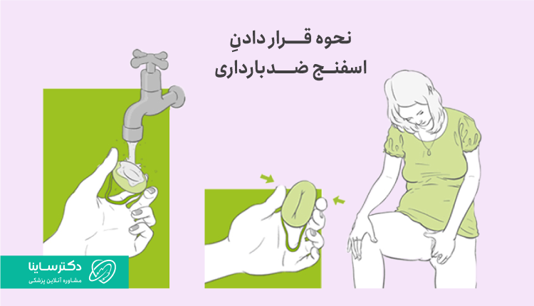نحوه قرار دادن اسفنج ضد بارداری در واژن