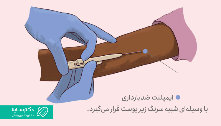 نحوه قرار دادن ایمپلنت ضد بارداری