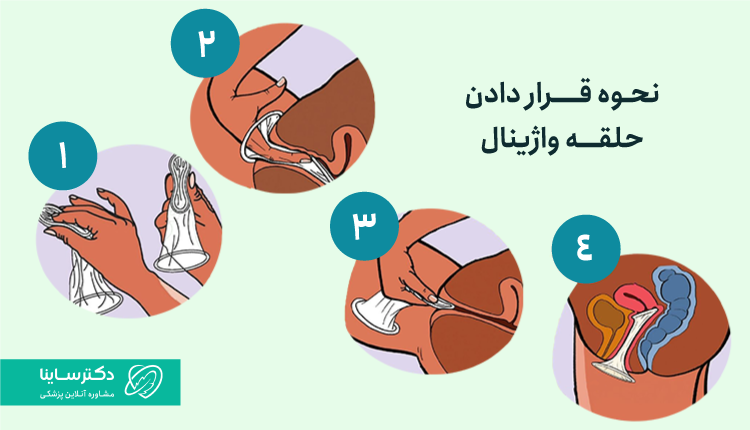 نحوه قرار دادن حلقه واژینال
