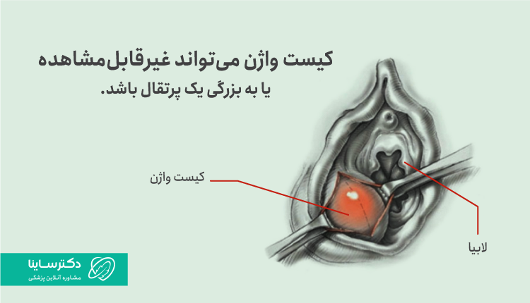 تصوویر کیست واژن و محل به‌وجود آمدن آن