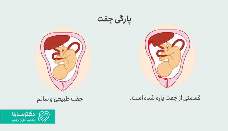 پاره شدن جفت، کاملا متفاوت با پاره شدن رحم است.