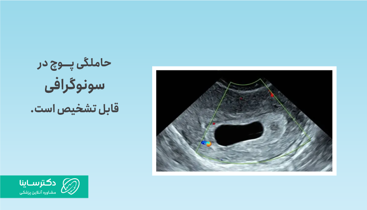 تشخیص حاملگی پوچ به کمک سونوگرافی واژینال