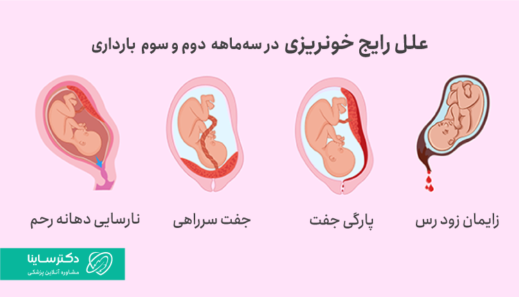 خونریزی در سه ماهه دوم و سوم بارداری