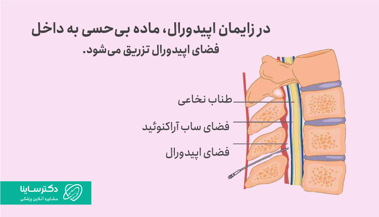 زایمان اپیدورال چیست