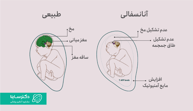 آنانسفالی چیست