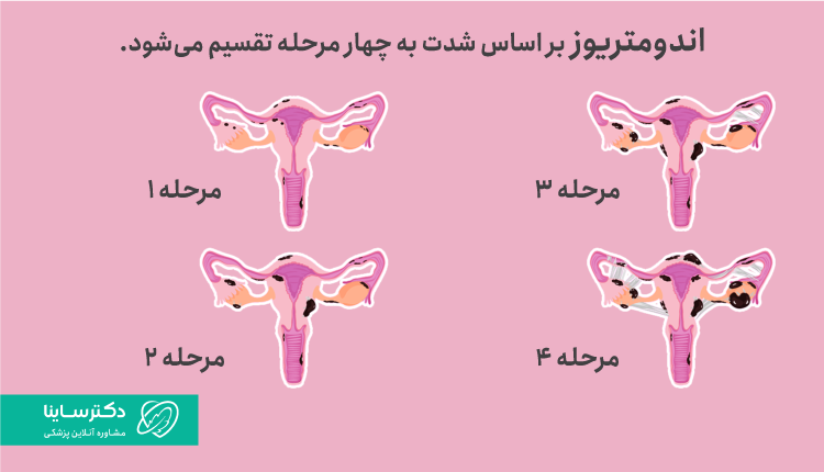 مراحل بیماری اندومتریوز