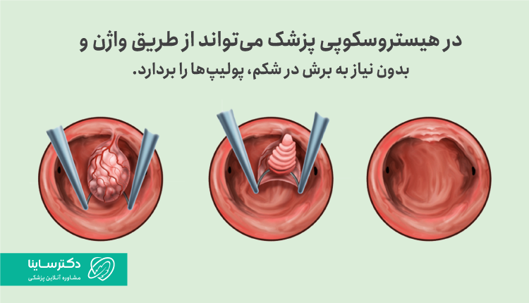 مراحل جراحی پولیپ رحم