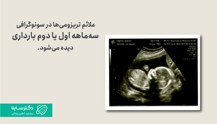 علائم تریزومی در بارداری به کمک سونوگرافی
