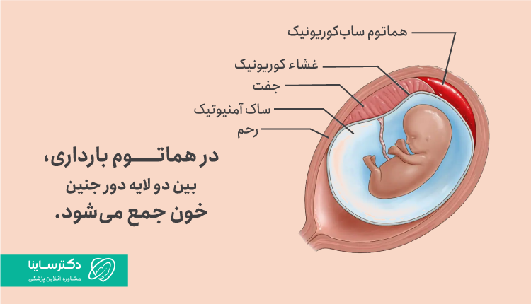 هماتوم در بارداری چیست