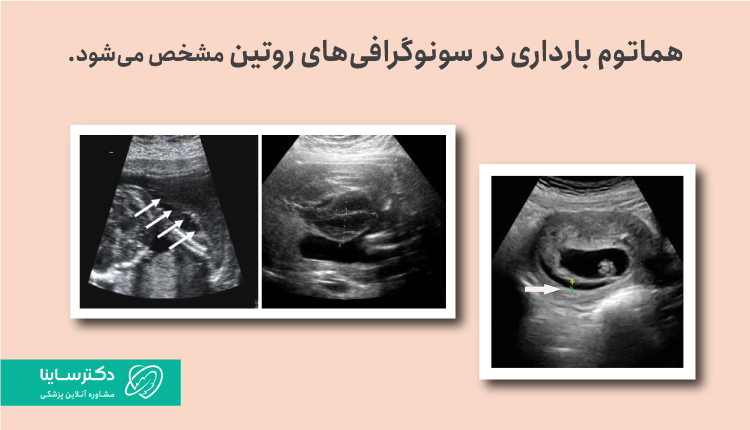 تشحیص هماتوم در بارداری به کمک سونوگرافی