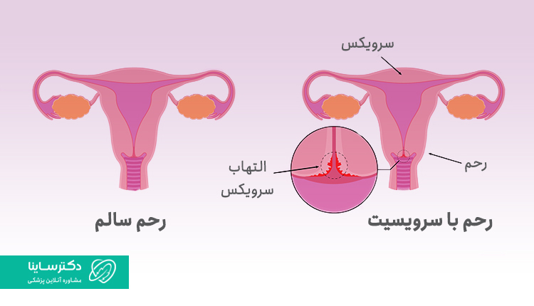 تفاوت رحم سالم با سرویسیت