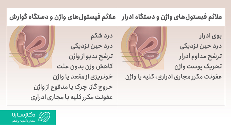 علائم فیستول واژن