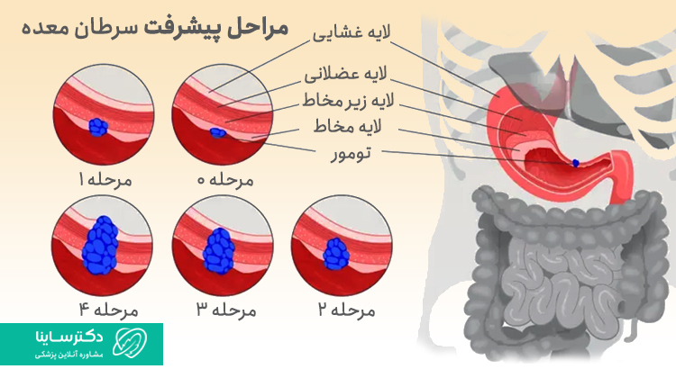 مراحل پیشرفت سرطان