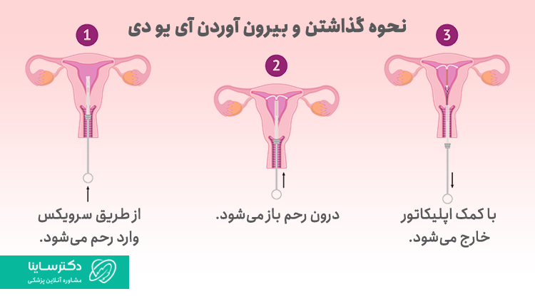 نحوه گذاشتن آی یو دی