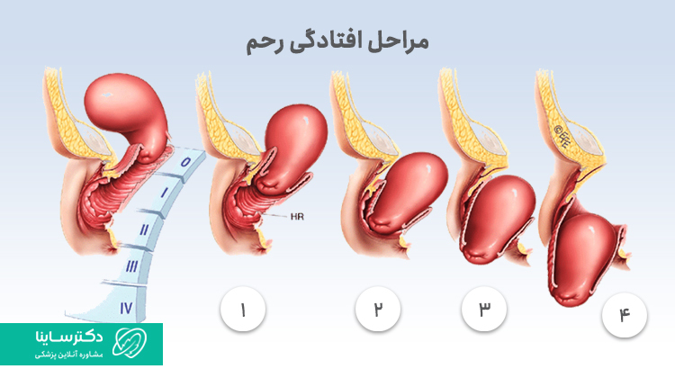 مراحل افتادگی رحم