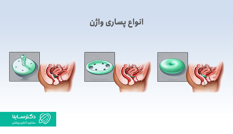 انواع پساری واژن برای درمان افتادگی رحم