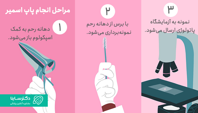 مراحل انجام تست پاپ اسمیر