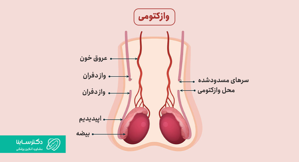 وازکتومی چیست