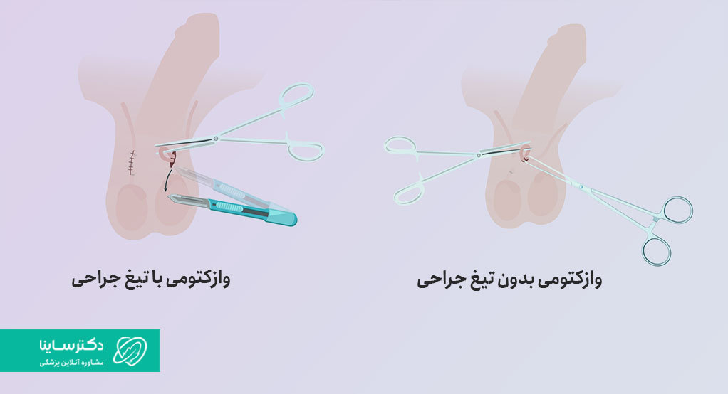 روش‌های انجام وازکتومی