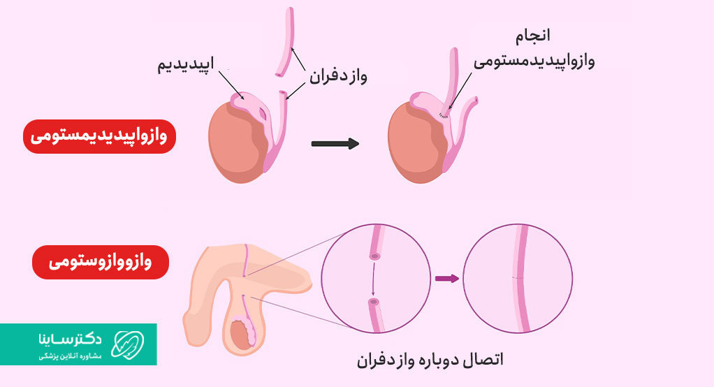 بازگشت وازکتومی
