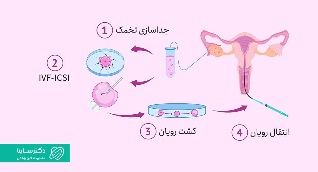 جایگزین عمل وازکتومی