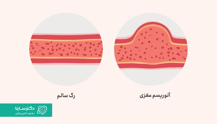 تفاوت آنوریسم مغزی و رگ سالم