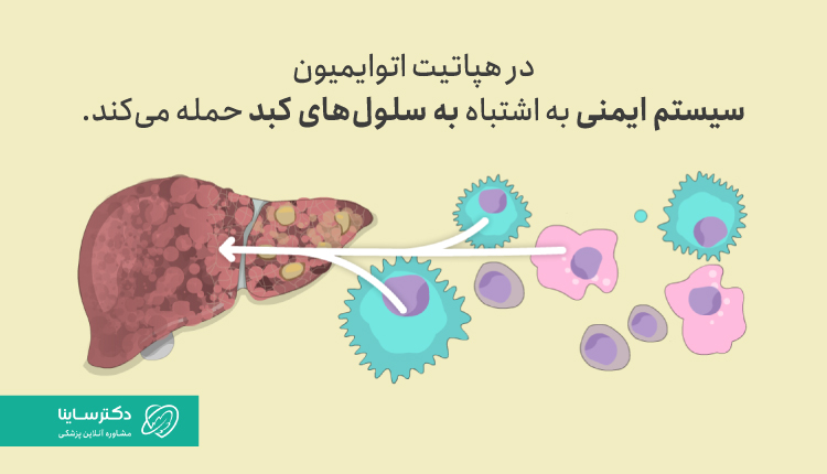 در هپاتیت اتوایمیون سیستم ایمنی به اشتباه به سلول‌های کبد حمله می‌کند.