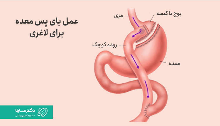 عمل بای پس معده برای لاغری