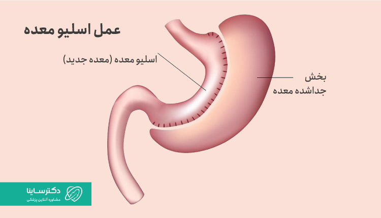 عمل اسلیو معده