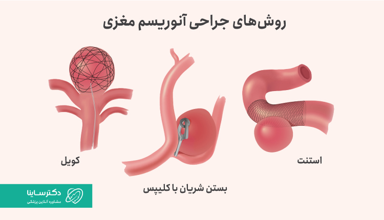 روش‌های جراحی آنوریسم مغزی