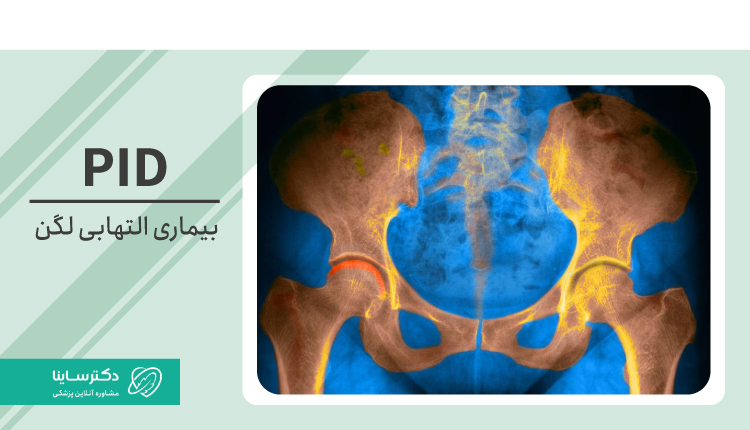 بیماری التهابی لگن یا PID چیست؟ علت، علائم، تشخیص و درمان