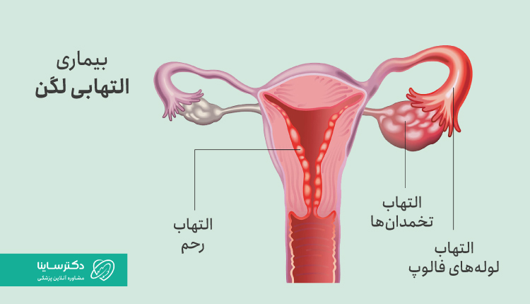 بیماری التهابی لگن، یک عفونت جدی است.