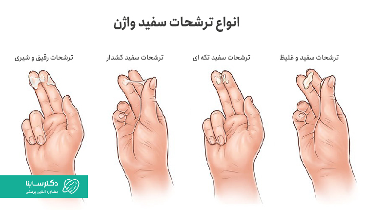 انواع ترشحات سفید واژن